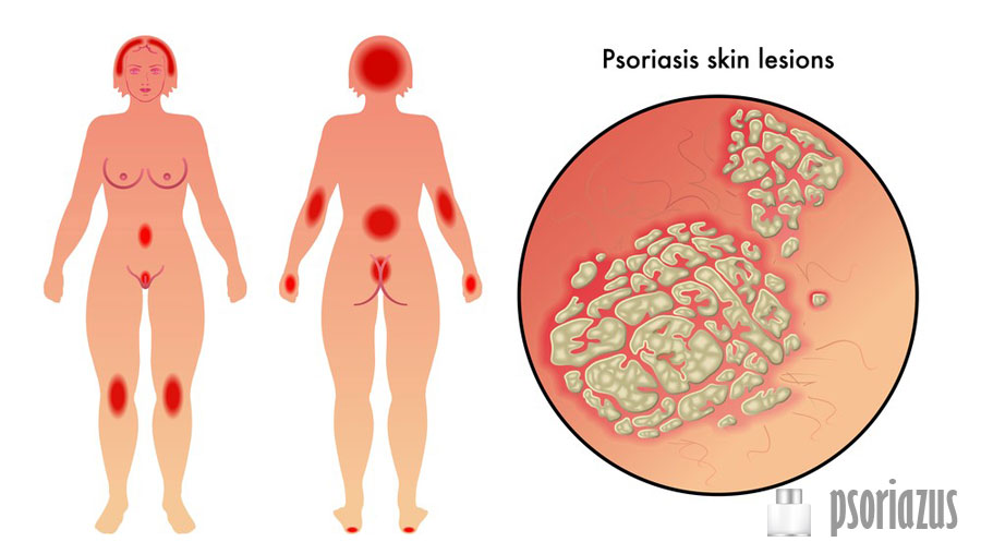 Как различить себорейный дерматит и псориаз