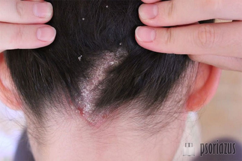 Уход за кожей и волосами при псориазе thumbnail
